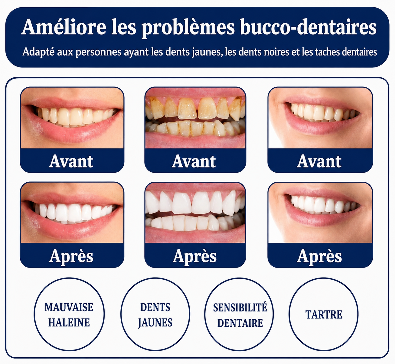 Blanchiment des dents